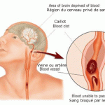 Comment éviter l'Accident Vasculaire Cérébral